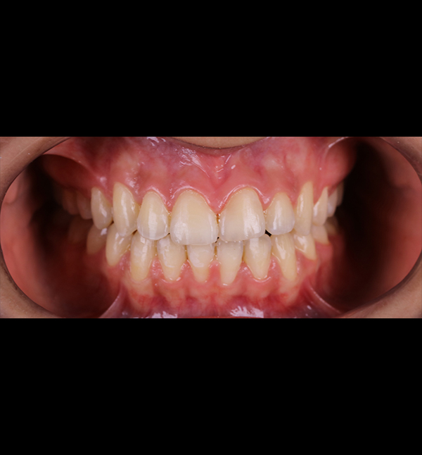 Before-facefive