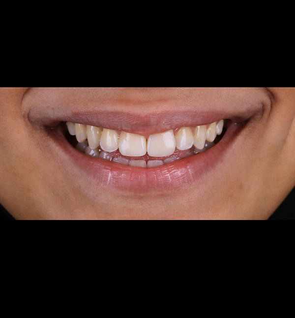 After-facetwo