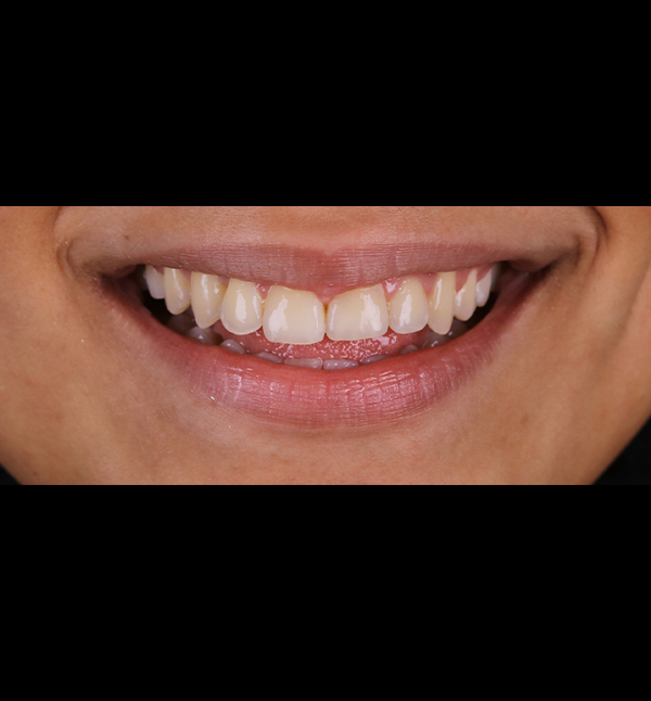 Before-facetwo